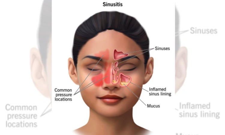 Surgery more effective in treating chronic sinus than antibiotics: Study