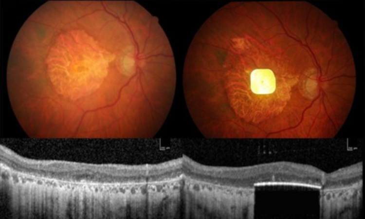 New retinal implant restores vision in patients with irreversible blindness New retinal implant restores vision in patients with irreversible blindness