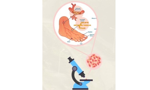 Nagaland University researchers find plant compound to treat diabetic wound, foot ulcers Nagaland University researchers find plant compound to treat diabetic wound, foot ulcers