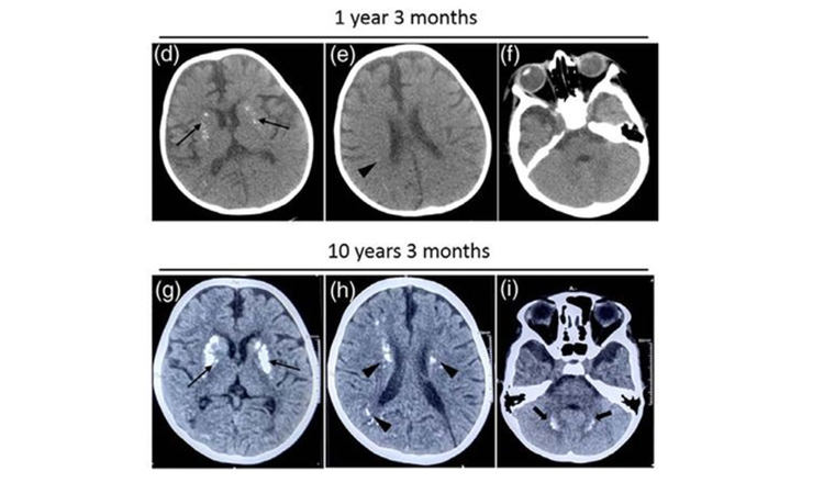 Indian researchers find rare gene mutation linked to recurrent neurological decline in kids Indian researchers find rare gene mutation linked to recurrent neurological decline in kids