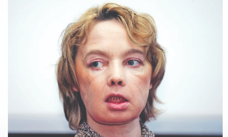 Unsettled futures: Unresolved questions of face transplants, 20 years on Unsettled futures: Unresolved questions of face transplants, 20 years on