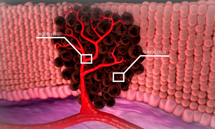 New antibody therapy shows promise for deadly blood cancer treatment