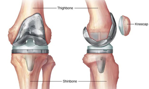 India needs more skilled surgeons for revision knee, hip replacement surgeries, say experts