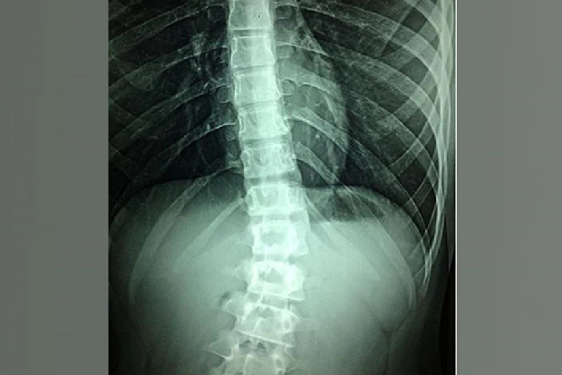 Radiofrequency spinal cord stimulation shows improved longer-lasting pain relief: Study