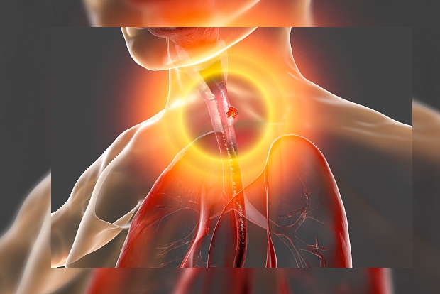 Study identifies genetic changes in patients who develop esophageal cancer