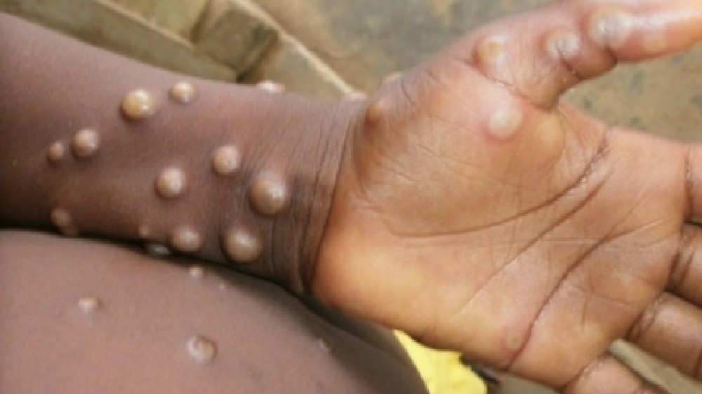 Monkeypox may persist in body for 10 weeks: Study