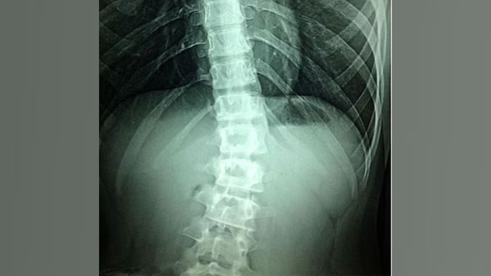 Spinal fractures in elderly avoidable with simple X-ray method