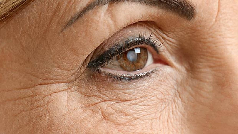 Cataract cases rise fivefold post pandemic in Chennai