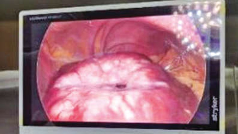 SRM Med College performs major liver surgery at nominal cost