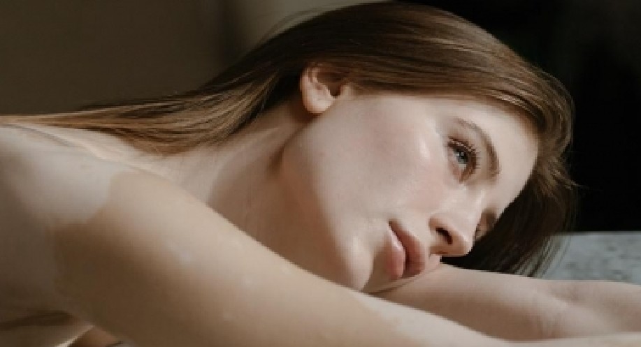 Is summer worsening your Melasma?