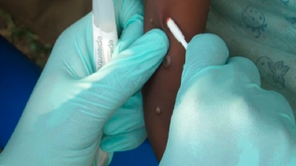 Africas alone in monkeypox deaths but has no vaccine doses