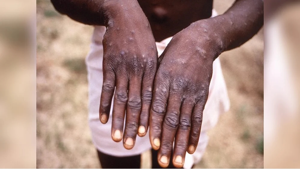 Telangana gearing up to tackle monkeypox outbreak, says Minister