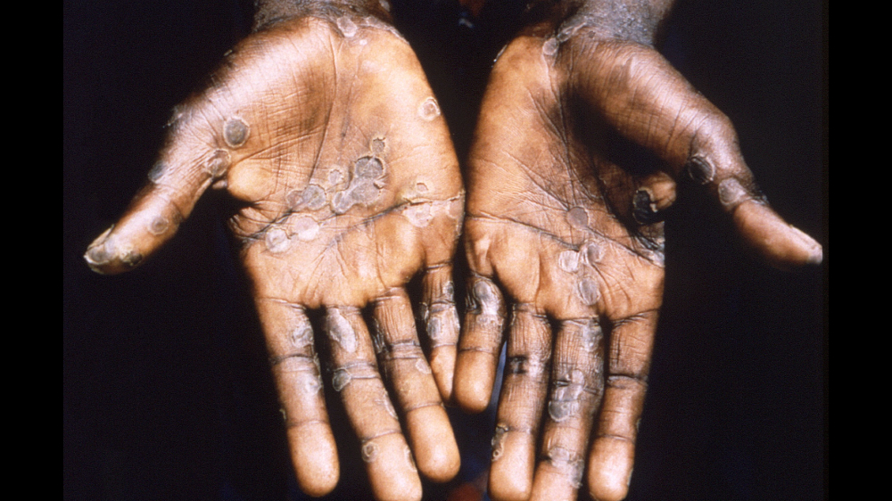 Possibility of monkeypox becoming a pandemic is low