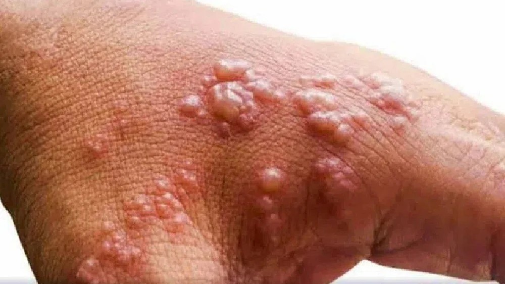 Safety, efficacy of tecovirimat in treating monkeypox: Study