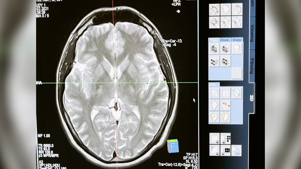 Blood tests in brain-injured patients predict death, disability Blood tests in brain-injured patients predict death, disability