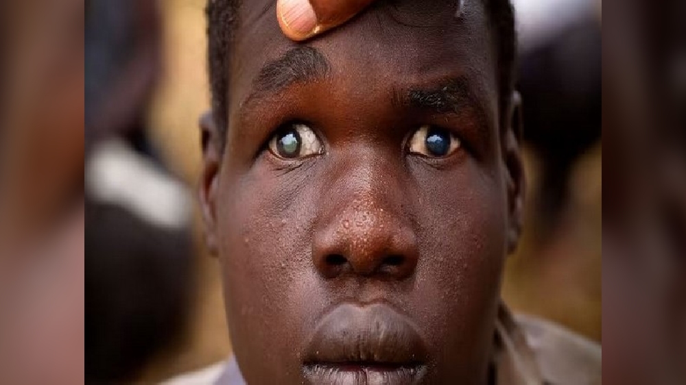 New diagnostic method for posterior uveitis eye disease found New diagnostic method for posterior uveitis eye disease found