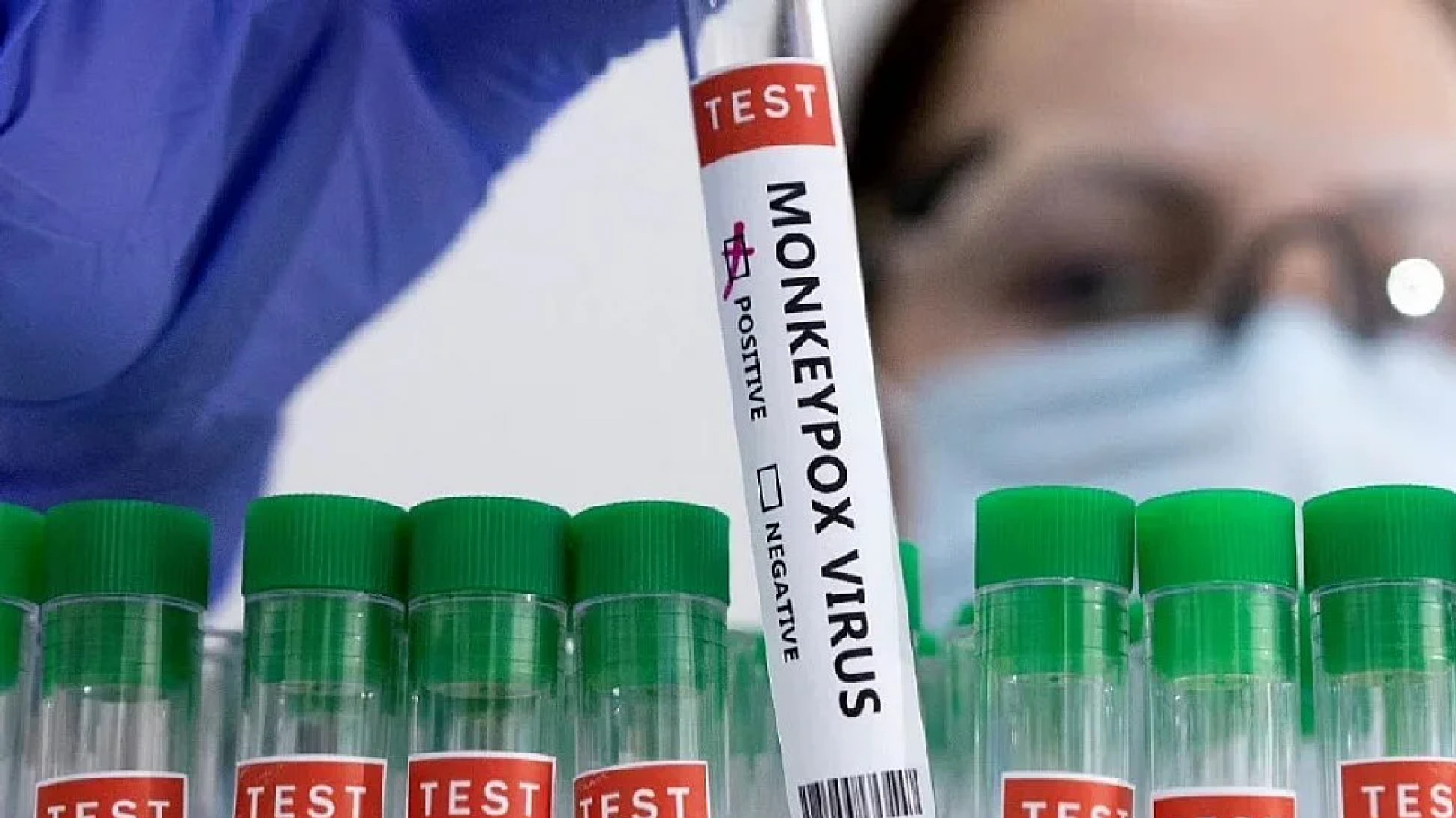 Rising Monkeypox cases will not lead to HIV: Top ICMR scientist