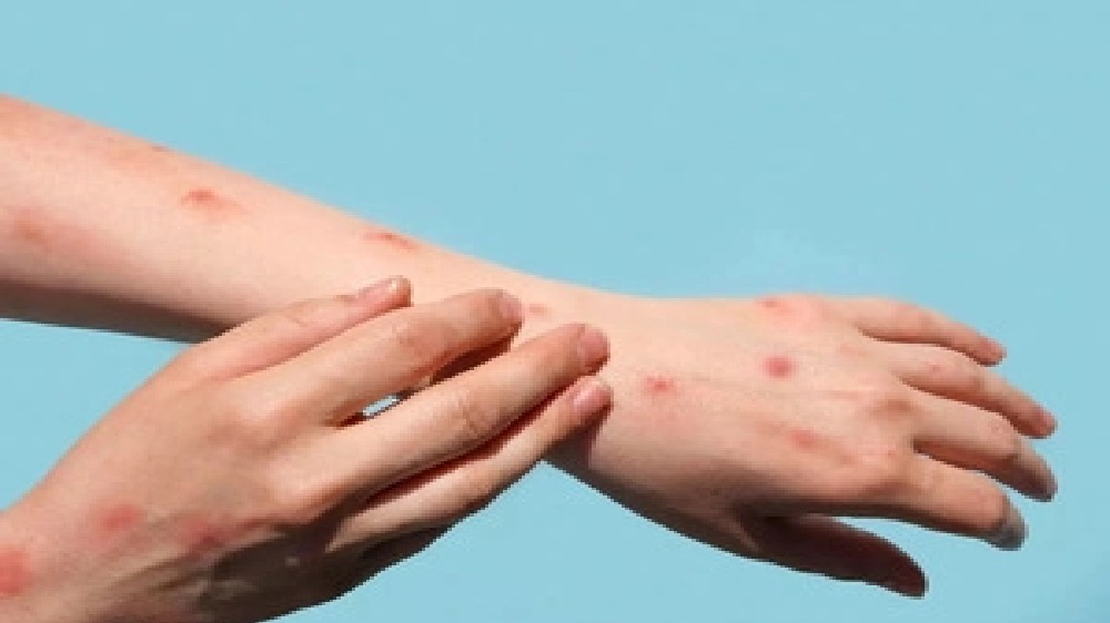 Delhi’s 1st monkeypox patient recovers, discharged from hospital