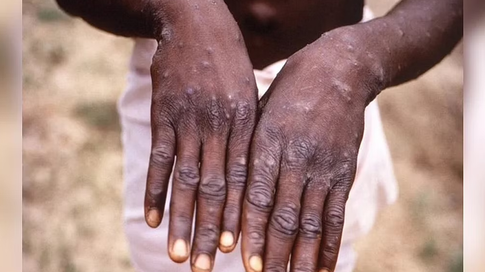History of Monkeypox cases in India: Details inside