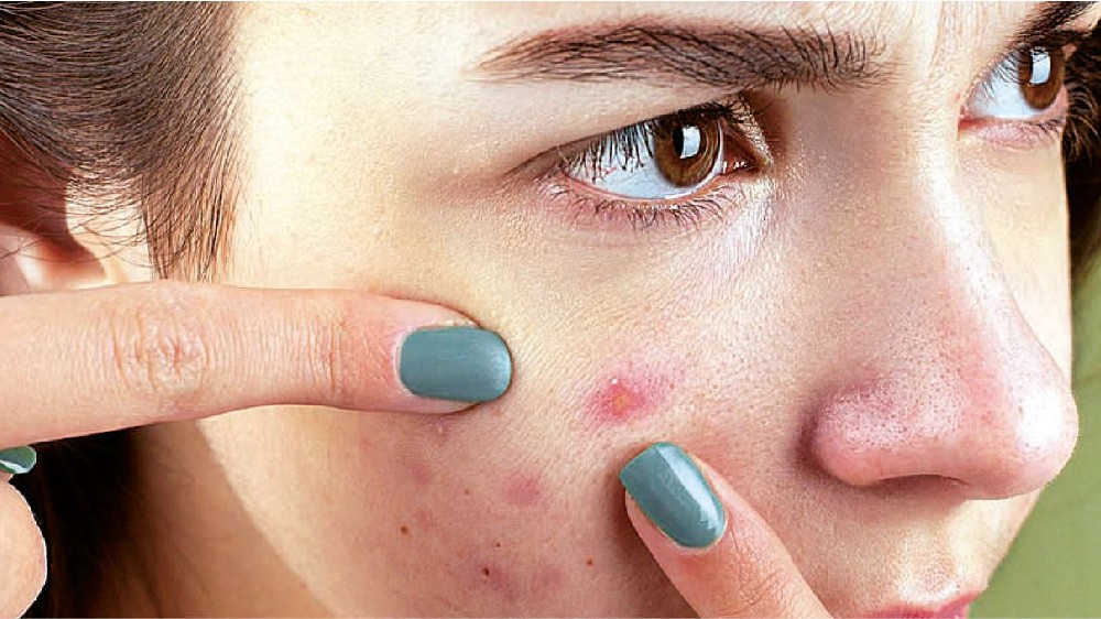 Acne – how to take care, and when should you meet the dermatologist?