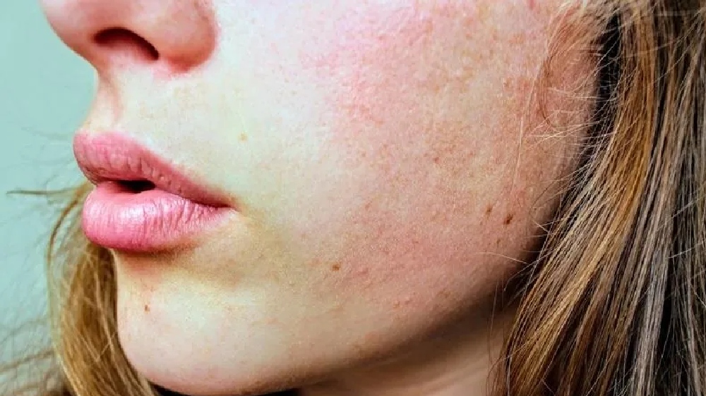 Myths and facts about chemical peeling