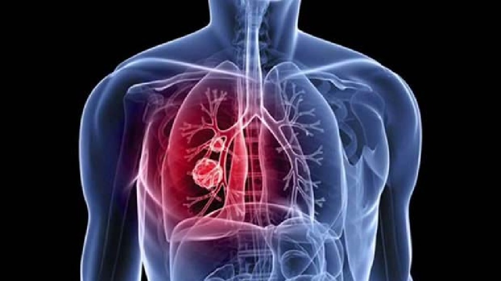 DT Health: Lung cancer increasing among women now