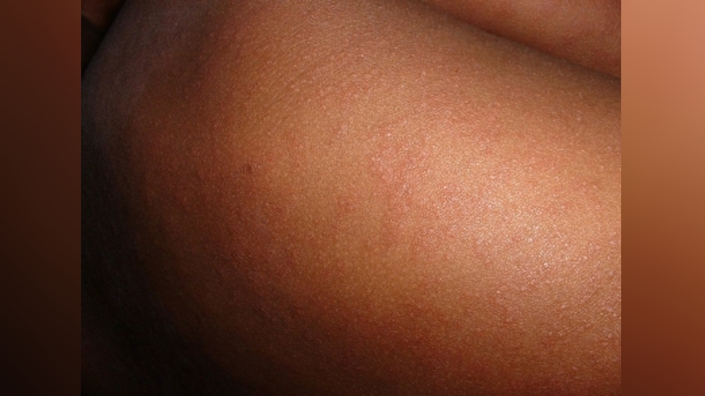 Aus state issues public health alert after detection of measles