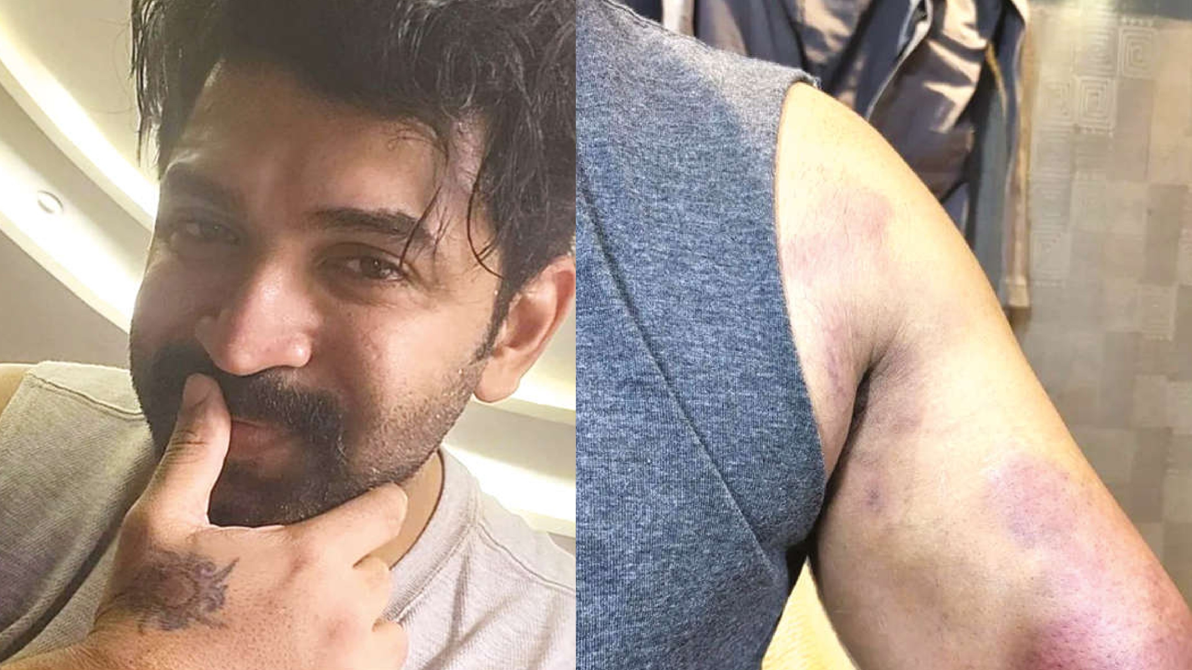 Arun Vijay injured again on the sets of Achcham Enbadhu Illaiye Arun Vijay injured again on the sets of Achcham Enbadhu Illaiye