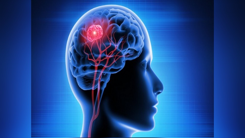 Genetic malfunction of brain astrocytes triggers migraine: Study