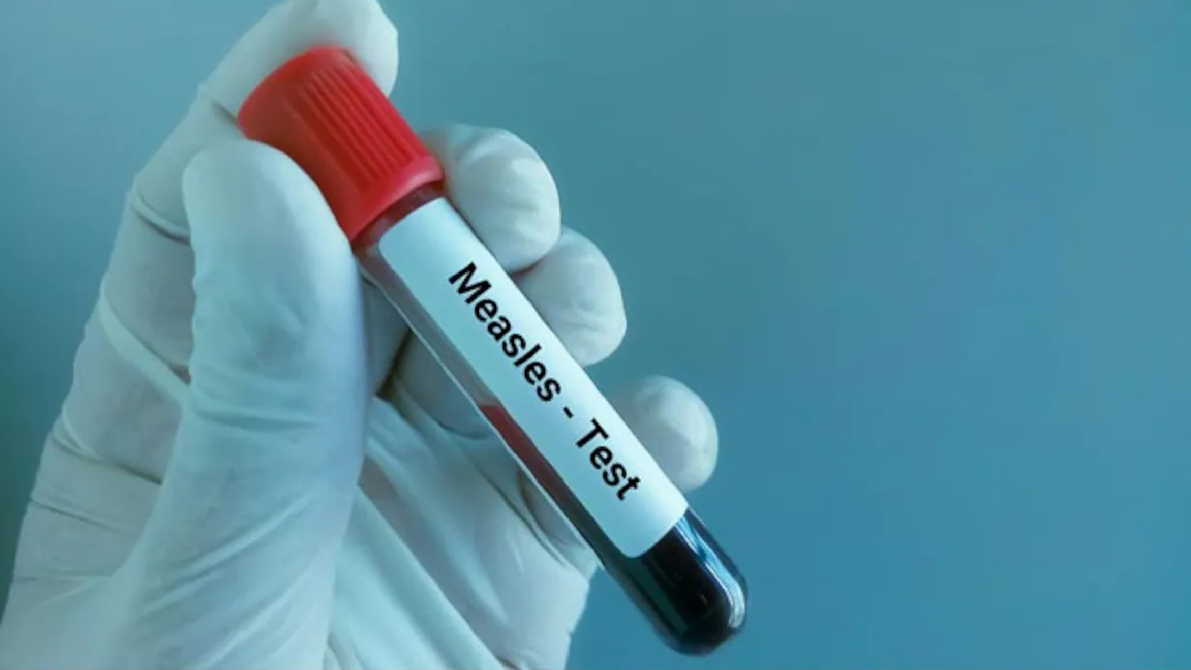 Mumbai records 13 new measles cases, one death