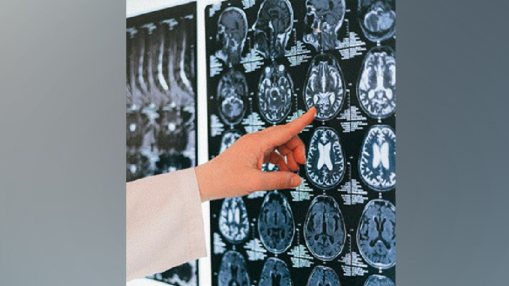 Study reveals antioxidant flavonols linked to slower memory decline