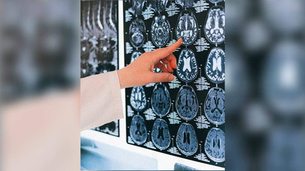 Storage mechanism of fear memories  lead to effective PTSD treatments
