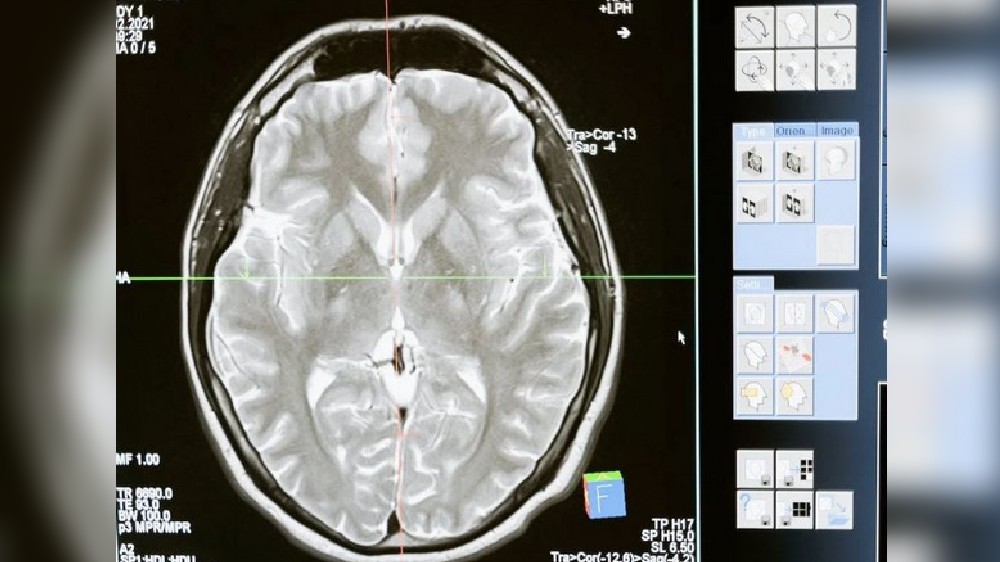 Study reveals link between metabolism changes, Huntingtons disease