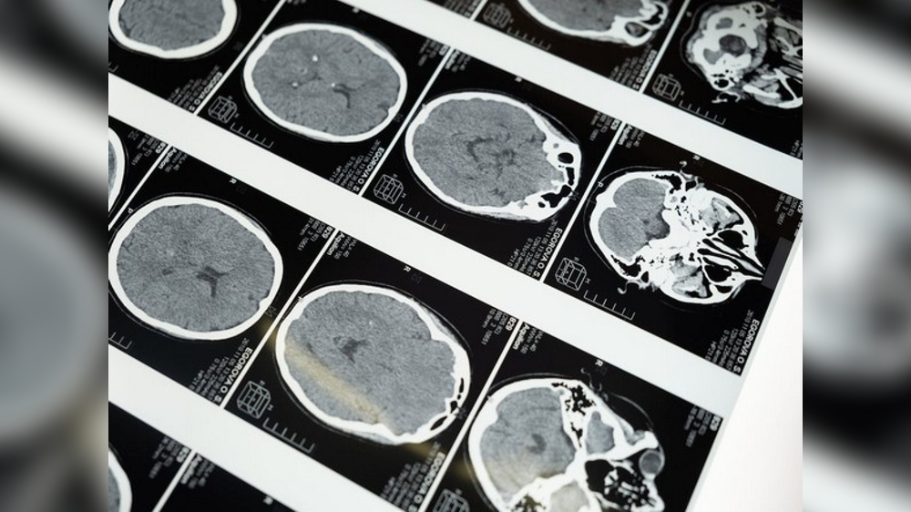 Study reveals how Huntingtons disease affects different neurons