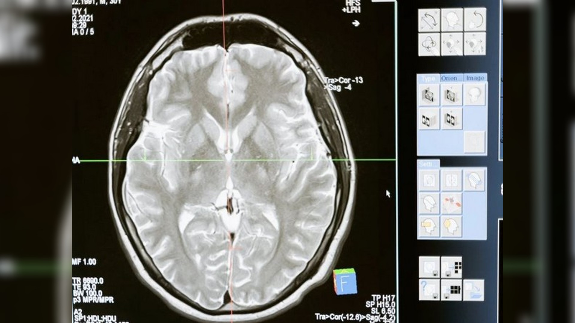 New artificial model helps antibody-based treatments to reach brain