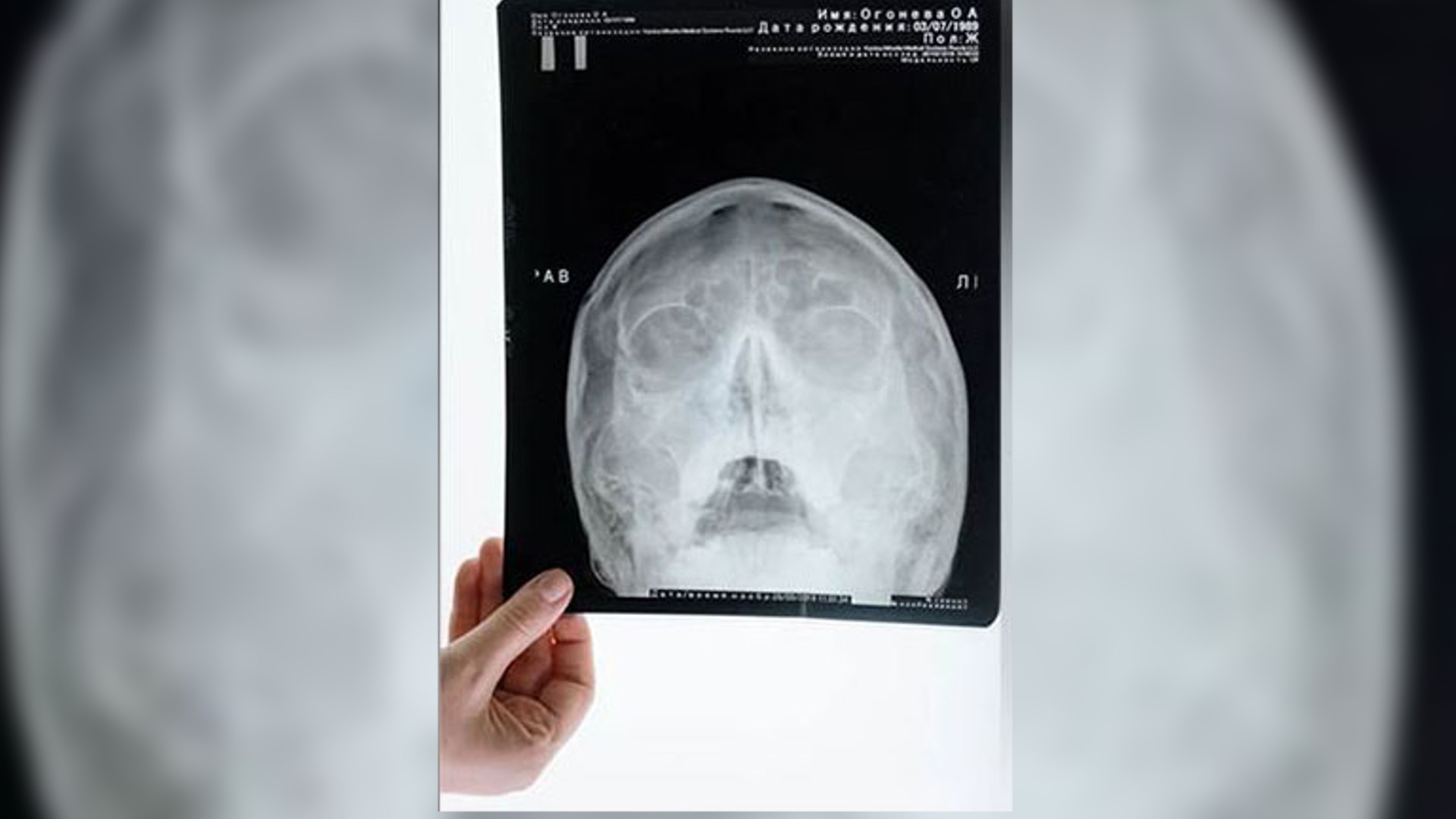 Study: Risk of skull fractures is higher in men than women