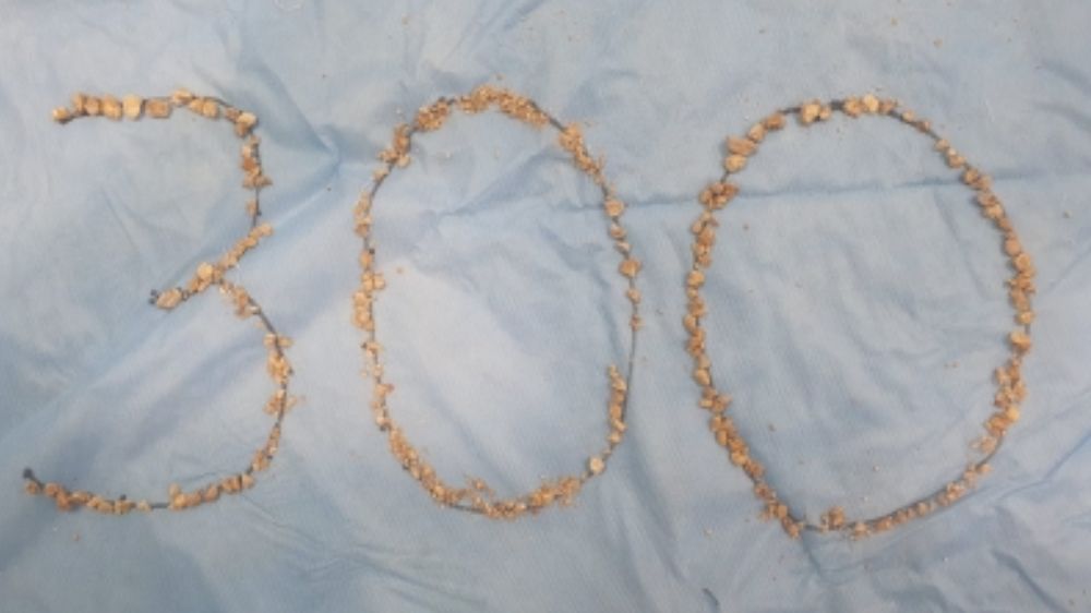 300 kidney stones removed from 75-yr-old farmer at Hyderabad’s AINU