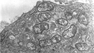 Better treatment found for deadly infection