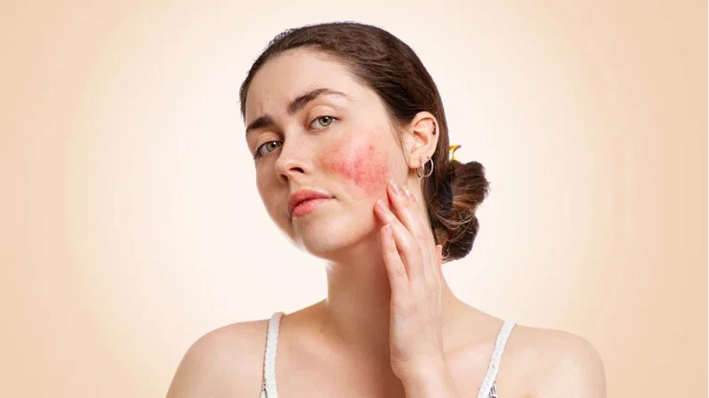 Lack of awareness on Lupus often leads to misdiagnosis, delayed treatment Lack of awareness on Lupus often leads to misdiagnosis, delayed treatment