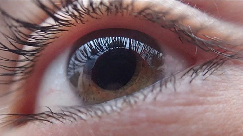 Cataract accounts for 82% of blindness cases in TN Cataract accounts for 82% of blindness cases in TN