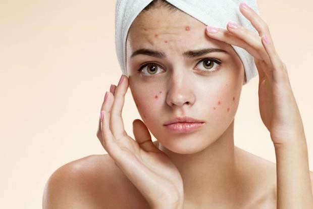 Beauty Tips: Keep acne at bay