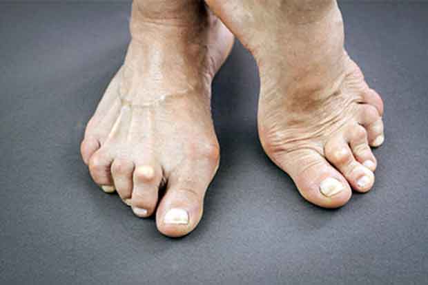 Get well soon: Rheumatoid arthritis can cause joint deformity