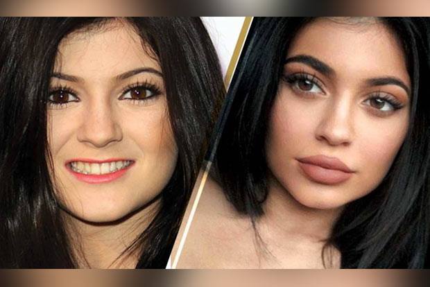 Lip fillers: Be aware of the before and after tricks