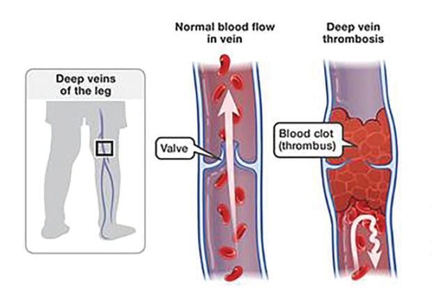 Deep vein thrombosis can cause death Deep vein thrombosis can cause death