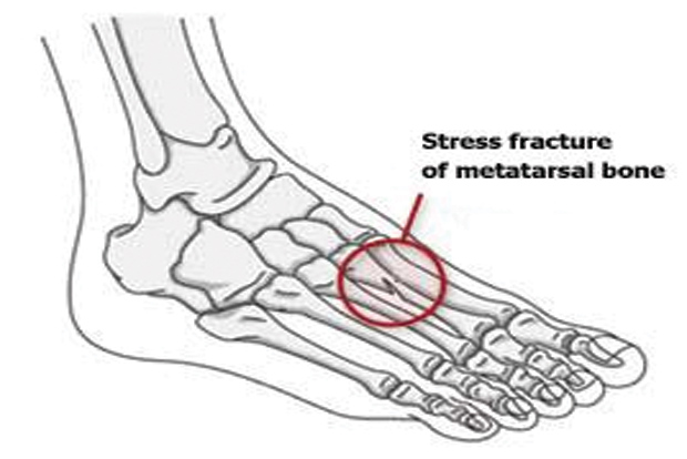 Stress fractures usually occur during training sessions