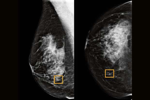 Study finds Google system could improve breast cancer detection