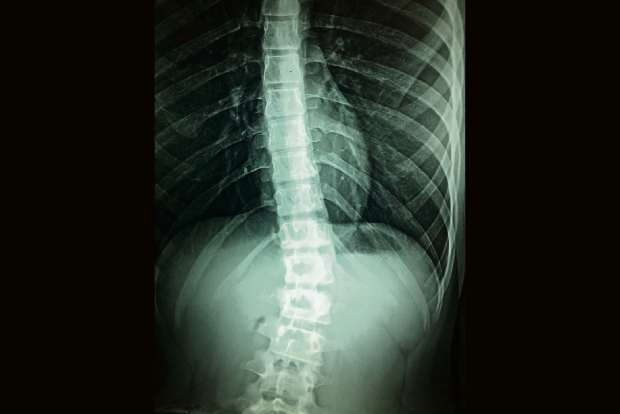 This robotic trunk to aid patients with spinal cord injury