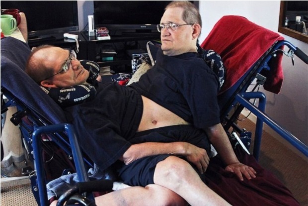 Worlds longest-surviving conjoined twin brothers die at 68 Worlds longest-surviving conjoined twin brothers die at 68