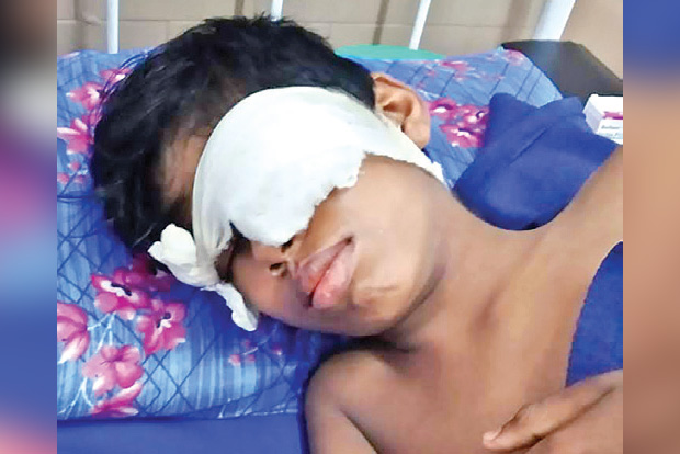 Class 8 boy hit with cane on head by teacher loses eyesight