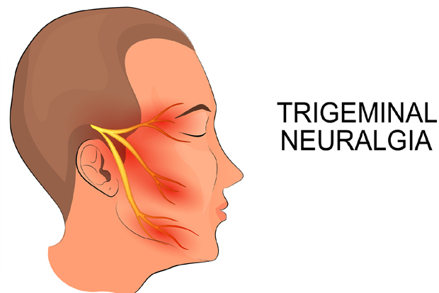 Trigeminal neuralgia can be cured medically and non-medically Trigeminal neuralgia can be cured medically and non-medically